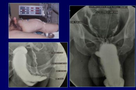 Terapia del tumore prostatico — figura 72