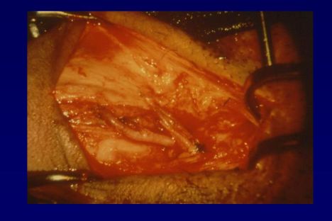 Arterializzazione vena dorsale profonda sec.virag 1-2-3- — Chirurgia vascolare del pene