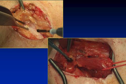 Microchirurgia del varicocele