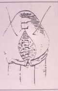 Micropene — Malformazioni congenite
