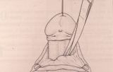 Micropene — Malformazioni congenite