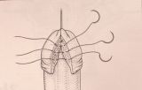 Micropene — Malformazioni congenite