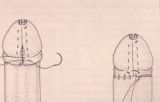 Micropene — Malformazioni congenite
