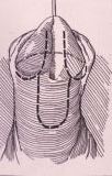 Micropene — Malformazioni congenite