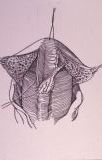 Micropene — Malformazioni congenite