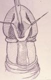 Micropene — Malformazioni congenite