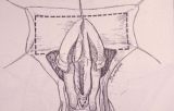 Micropene — Malformazioni congenite