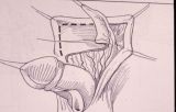 Micropene — Malformazioni congenite