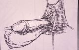 Micropene — Malformazioni congenite