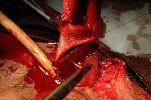 Micropene — Malformazioni congenite