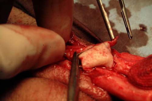 Micropene — Malformazioni congenite