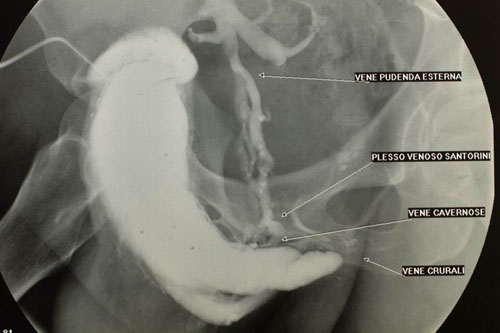Quali esami sono necessari per diagnosticare la D.E. ? — Disfunzione erettile