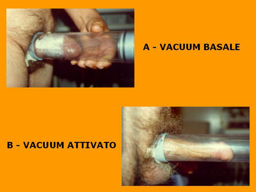 Quali esami sono necessari per diagnosticare la D.E. ? — Disfunzione erettile