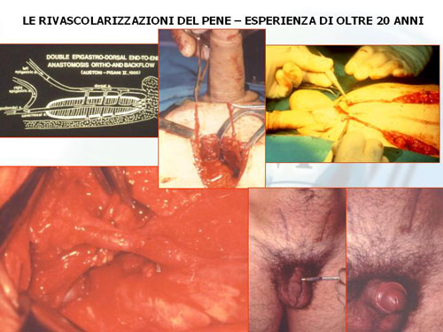Gli interventi di rivascolarizzazione del pene — Disfunzione erettile
