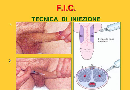 Trattamenti di 2° livello — Disfunzione erettile
