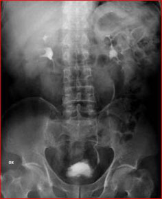 Diagnosi — Calcolosi