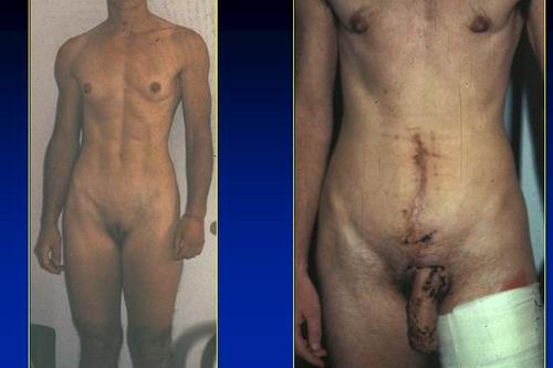 la clitoridopessia alla base del neo pene (sec.Austoni 1990) — Disturbi di Genere