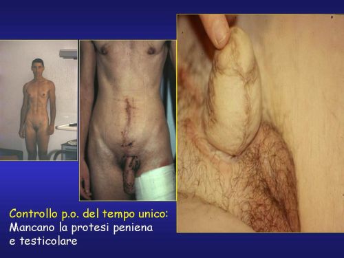 (Clitoridofallopessia sec.Austoni) — Falloplastica