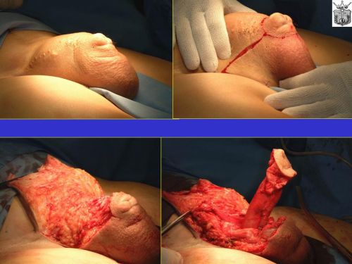 Falloplastiche parziali — Falloplastica