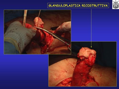 Falloplastiche parziali — Falloplastica
