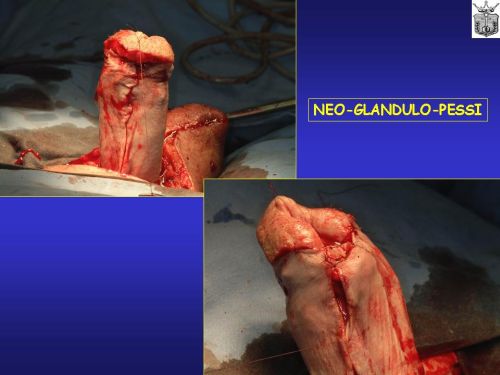 Falloplastiche parziali — Falloplastica