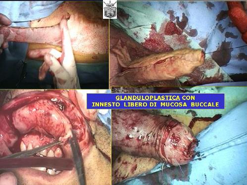 Falloplastiche parziali — Falloplastica