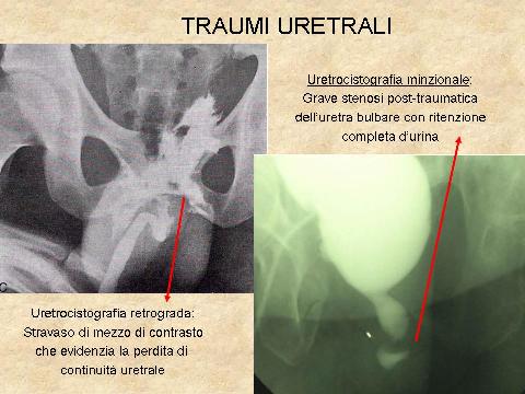 Uretrocistografia retrograda e minzionale — Stenosi uretrali