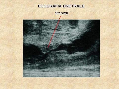 Ecografia — Stenosi uretrali