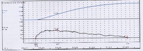 Uroflussimetria patologica — Stenosi uretrali