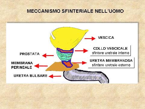 POSTERIORE: Membranosa, Prostatica — Stenosi uretrali