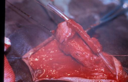 Micropene — Malformazioni congenite