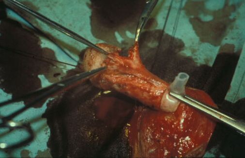 Micropene — Malformazioni congenite