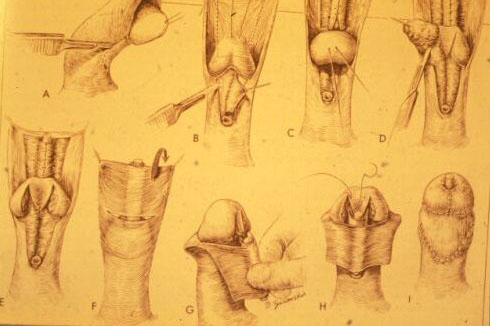 Micropene — Malformazioni congenite