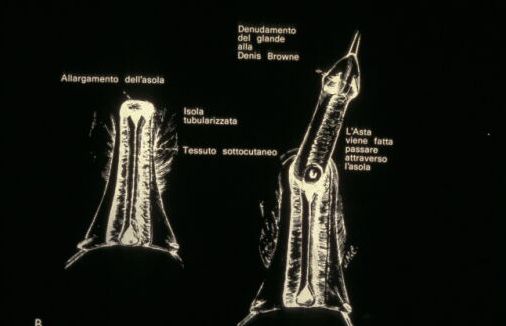 Micropene — Malformazioni congenite