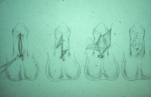 Micropene — Malformazioni congenite