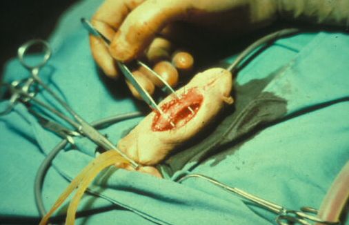 Micropene — Malformazioni congenite
