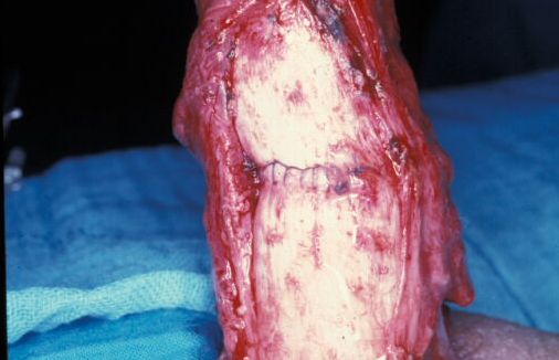 Micropene — Malformazioni congenite