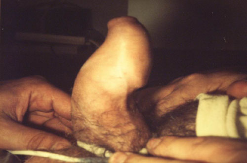 "sintesi di trent'anni di esperienza del PROF.austoni sulla sulla malattia di lapeyronie" — Pene Curvo – Malattia di La Peyronie