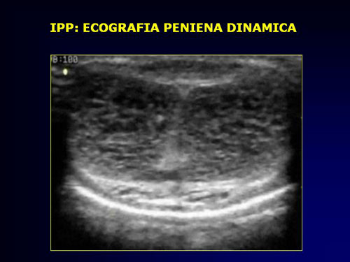 Quali esami sono necessari per diagnosticare l'IPP ? — Pene Curvo – Malattia di La Peyronie