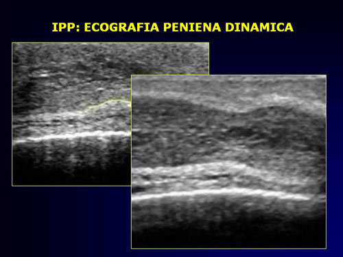 Quali esami sono necessari per diagnosticare l'IPP ? — Pene Curvo – Malattia di La Peyronie