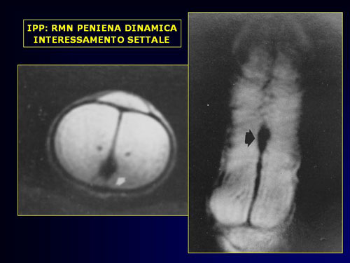 Quali esami sono necessari per diagnosticare l'IPP ? — Pene Curvo – Malattia di La Peyronie