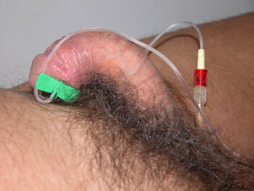 Quali esami sono necessari per diagnosticare l'IPP ? — Pene Curvo – Malattia di La Peyronie