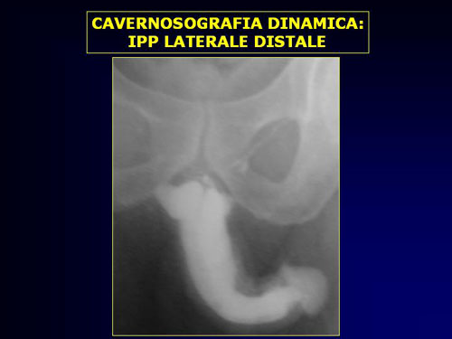 Quali esami sono necessari per diagnosticare l'IPP ? — Pene Curvo – Malattia di La Peyronie