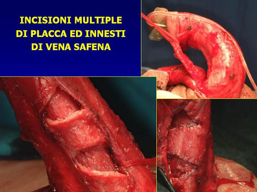 Incisioni della placca e graft sefenici di copertura (sec.Austoni 1) — Pene Curvo – Malattia di La Peyronie
