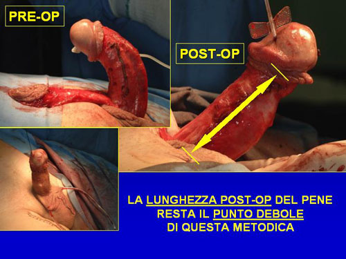 Incisioni della placca e graft sefenici di copertura (sec.Austoni 1) — Pene Curvo – Malattia di La Peyronie