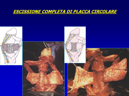 Asportazione completa della placca + innesti liberi o vascolarizzati — Pene Curvo – Malattia di La Peyronie