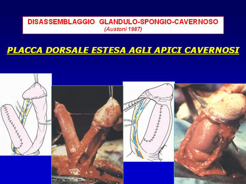 Asportazione completa della placca + innesti liberi o vascolarizzati — Pene Curvo – Malattia di La Peyronie