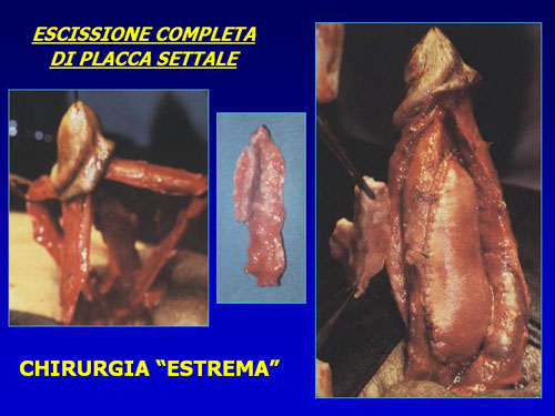 Asportazione completa della placca + innesti liberi o vascolarizzati — Pene Curvo – Malattia di La Peyronie