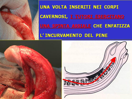 Asportazione completa della placca + innesti liberi o vascolarizzati — Pene Curvo – Malattia di La Peyronie