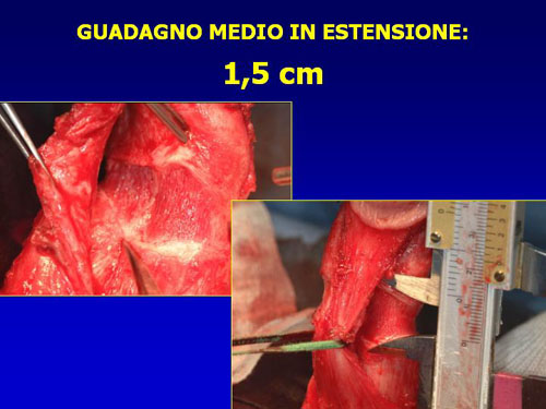 Asportazione completa della placca + innesti liberi o vascolarizzati — Pene Curvo – Malattia di La Peyronie